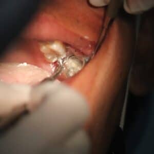 Photo Dental Implant Consultation