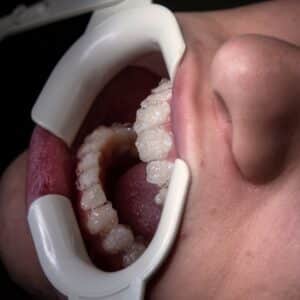 Photo Dental Implants Chandler AZ