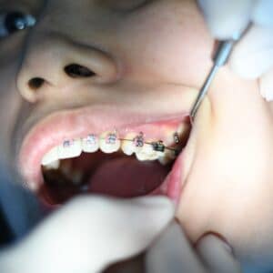 Photo Teeth Replacement