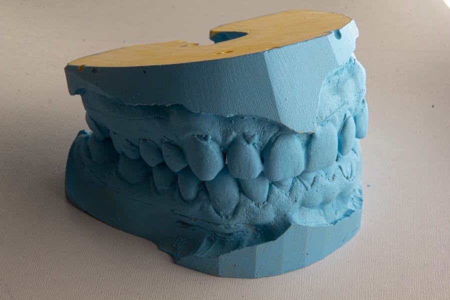 Photo Dental Implants Chandler Az