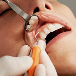 Photo Dental Implants