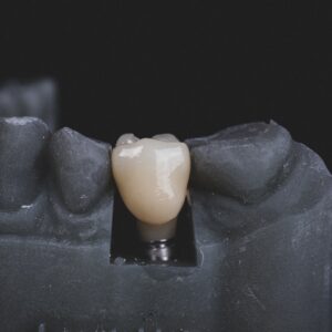 Photo Dental Implant Cost