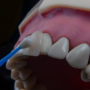 Photo Dental Implant Process Timeline