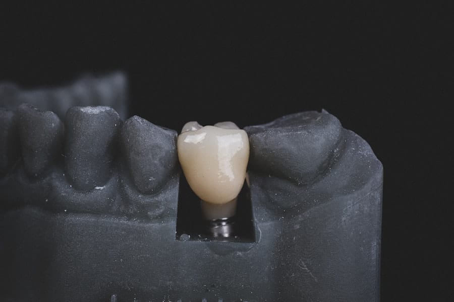 Photo Dental Implant Process Timeline