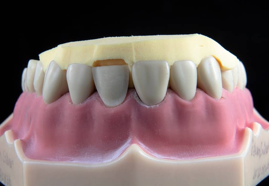 Photo Dental Implant Surgery