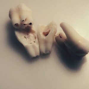 Photo Tooth Replacement