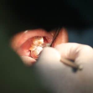 Photo Dental Implant Cost Estimate