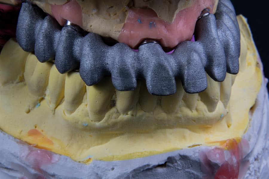 Photo Implant Dentist