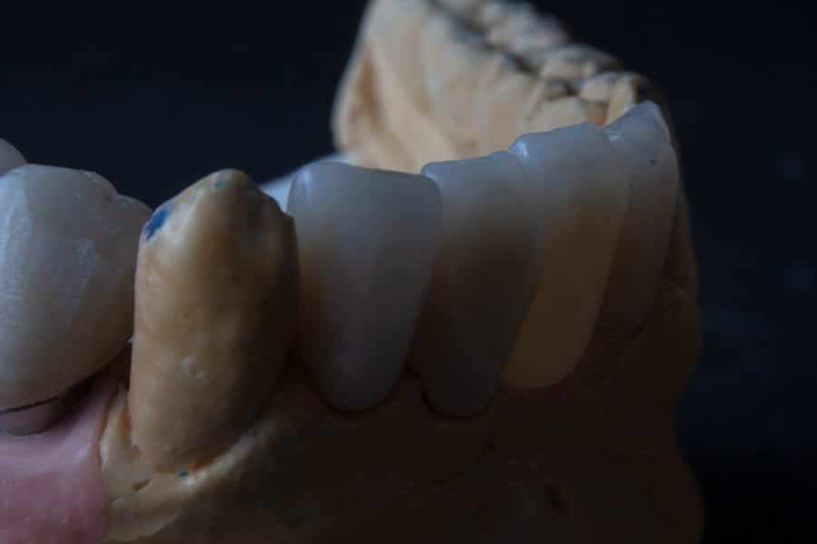 Tooth Implants