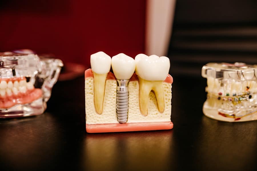 Tooth Implant Cost