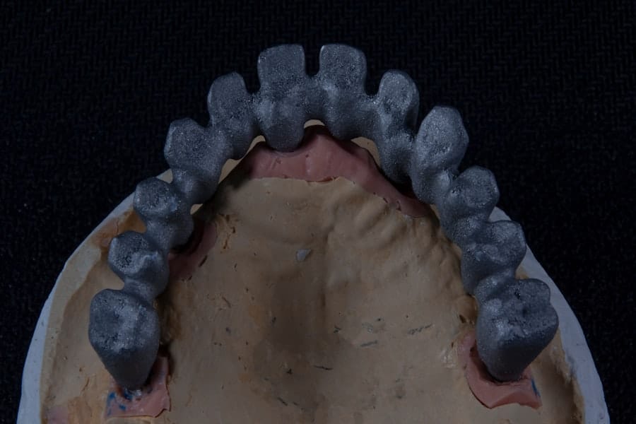 Replacing Missing Teeth