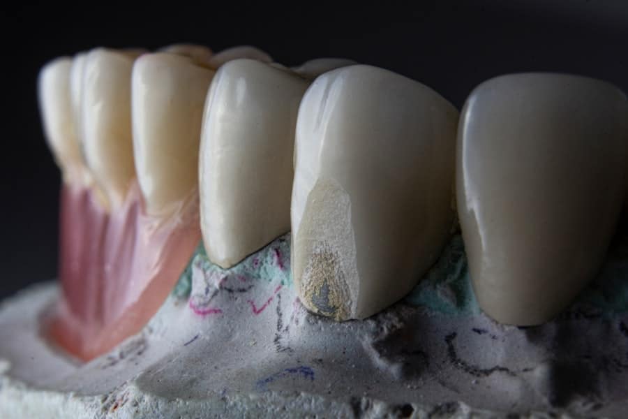 Photo Tooth Implant Cost