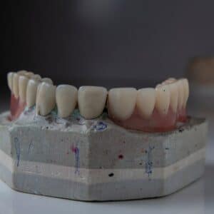 Photo Dental Implant Cost