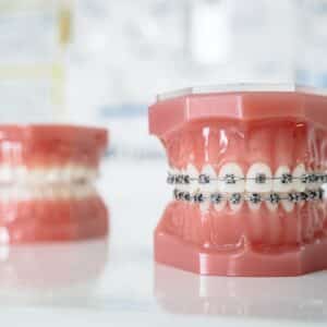 Photo Dental Implants