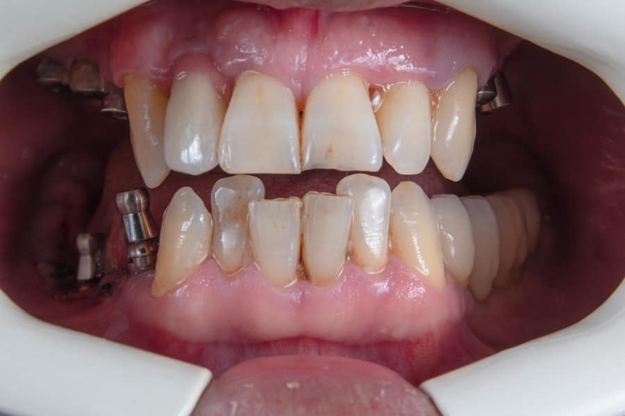 Photo Dental Implant Clinic