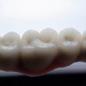 Photo Tooth Implants