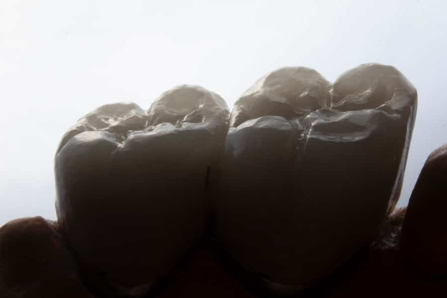 Photo Tooth Implants