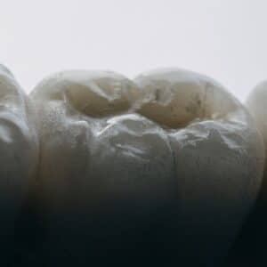 Photo Dental Implant Cost