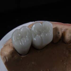 Photo Dental Implants