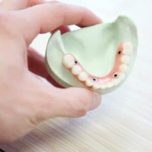Photo Implant Supported Dentures