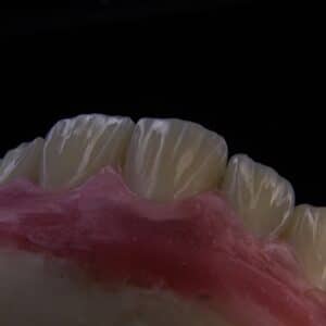 Photo Dental Implants