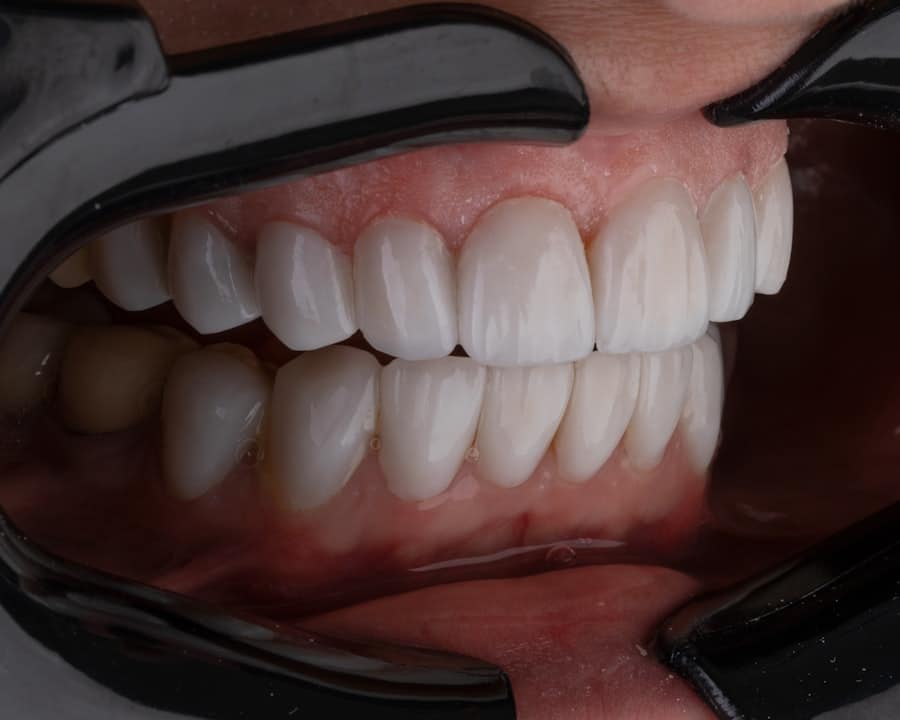 Photo Dental Implants